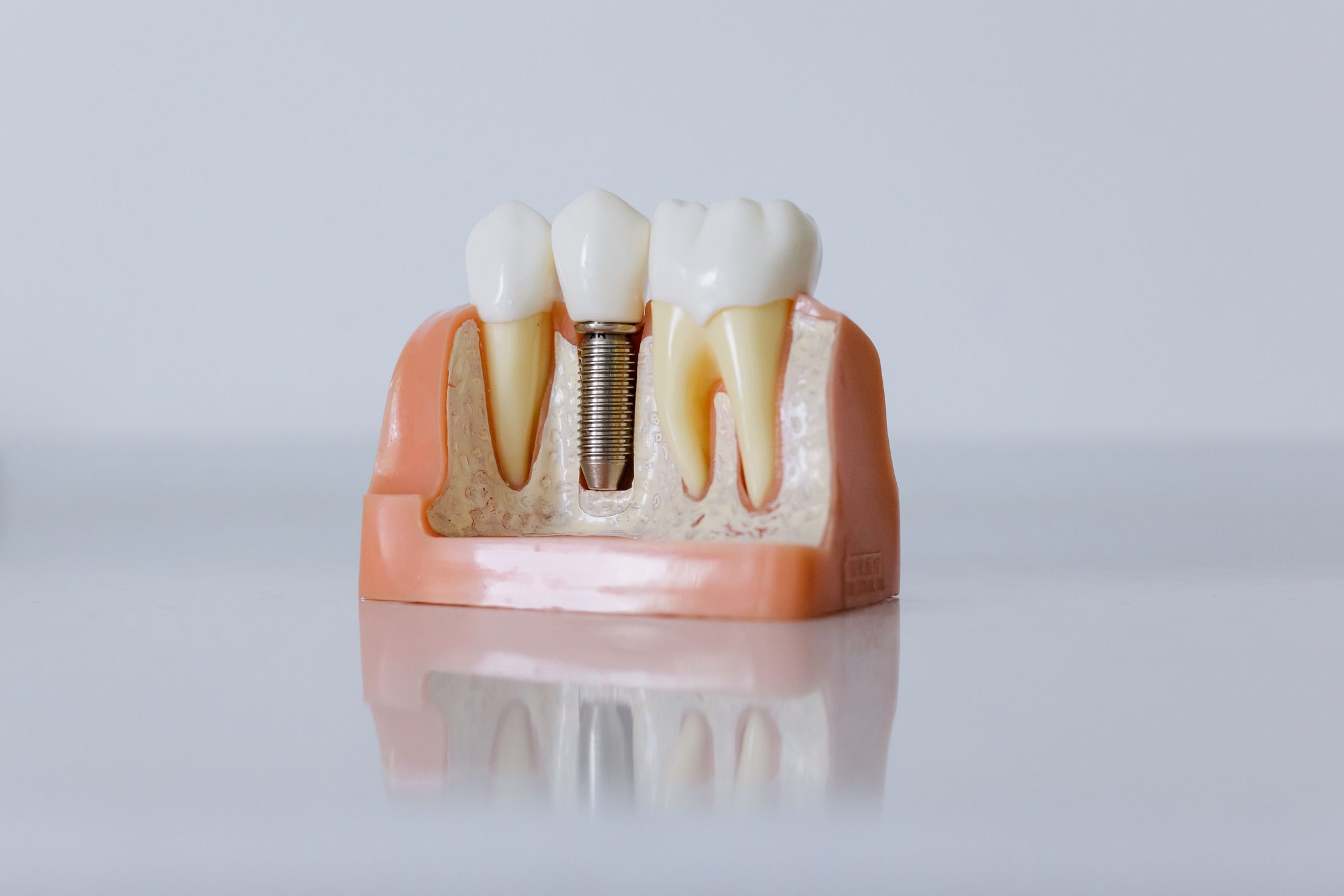Dental implant, abutment, and crown model shown on a reflective surface