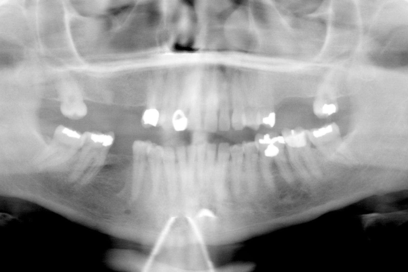Panoramic dental X-ray showing a full set of teeth
